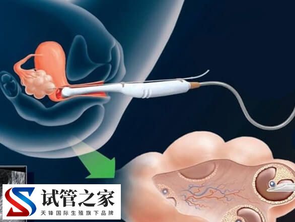 取卵不打麻药和造影哪个疼(图2)