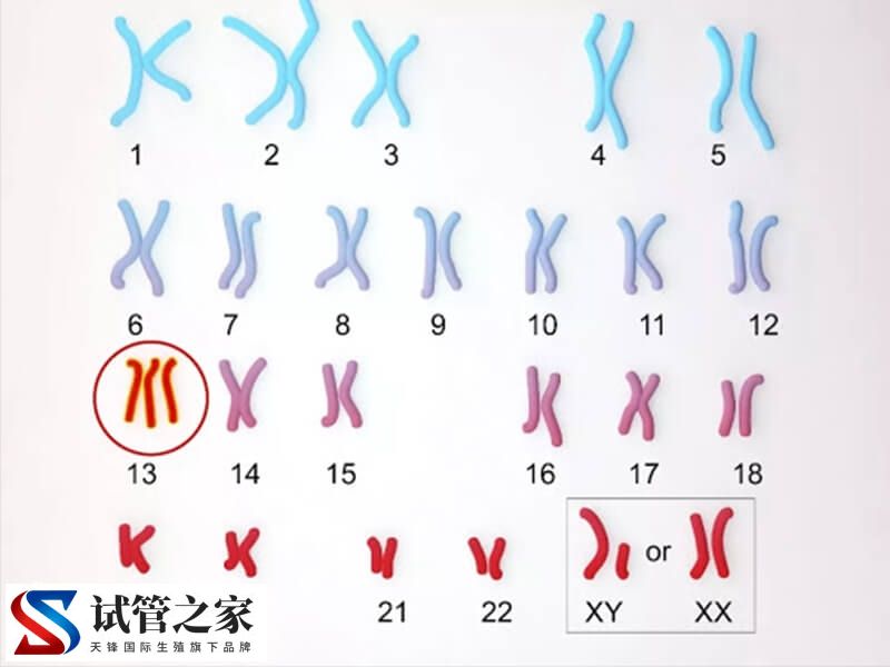 唐氏综合征21号异常染色体引发的危害