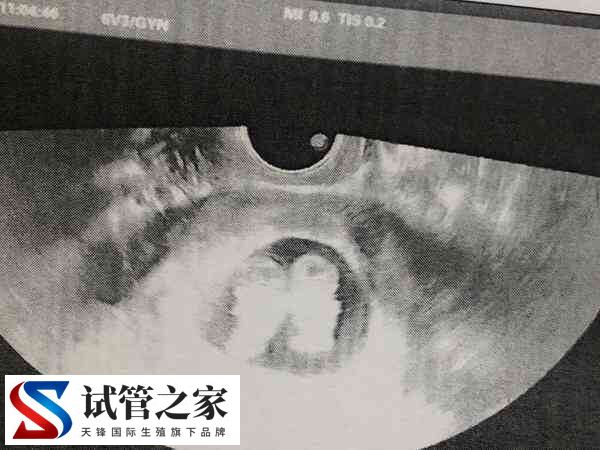 试管婴儿双胞胎的几率比自然受孕高，能达到20%了吗？