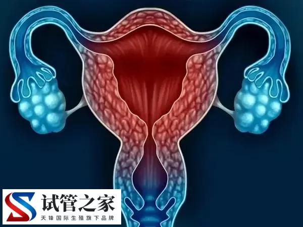 子宫内膜异位会影响女性生育能力，那还可以自然怀孕吗？