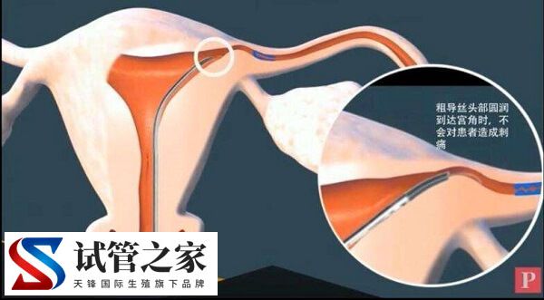 做了输卵管疏通6个月了为什么还是怀不了孕？