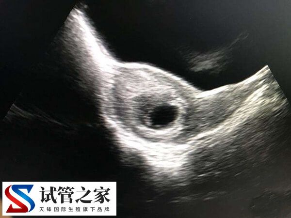 试管为什么胎停率那么高