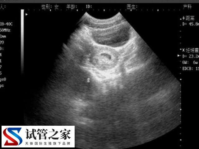 乳腺低回声影不影响试管(图2)