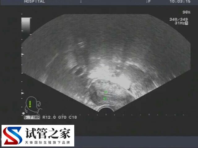 宫颈肥大做试管婴儿会不会影响着床