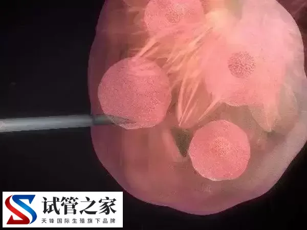 内膜癌逆转后对试管有没有影响(图2)