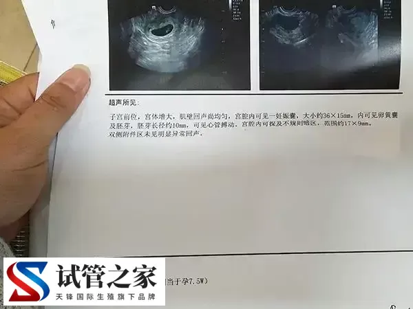 脑供血不足做试管有没有影响