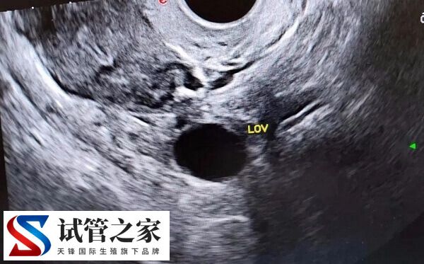 注射绒促性素有哪些不良反应(图4)