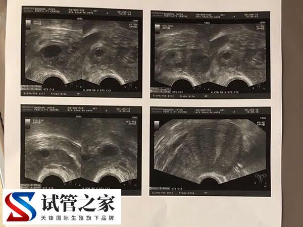试管短方案取卵只取到一个怎么回事(图3)