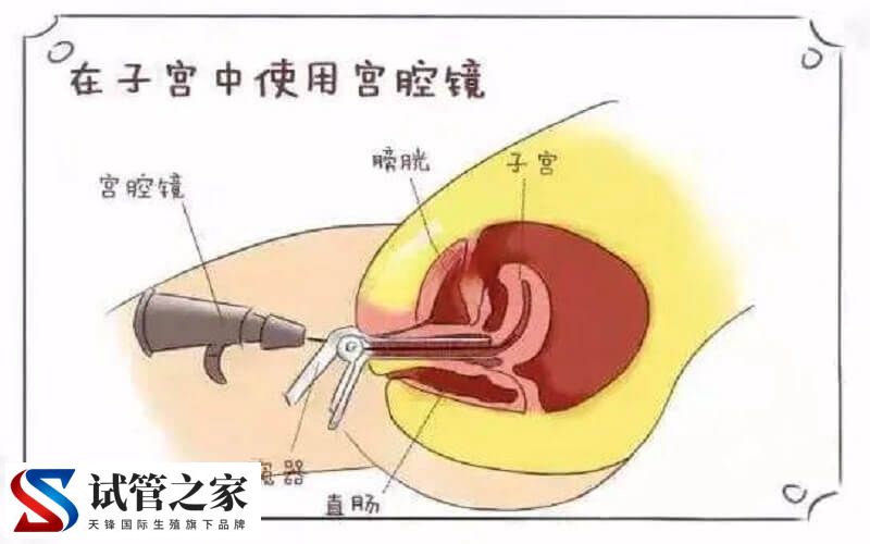 做宫腔镜检查痛不痛(图1) 做宫腔镜检查痛不痛(图1)