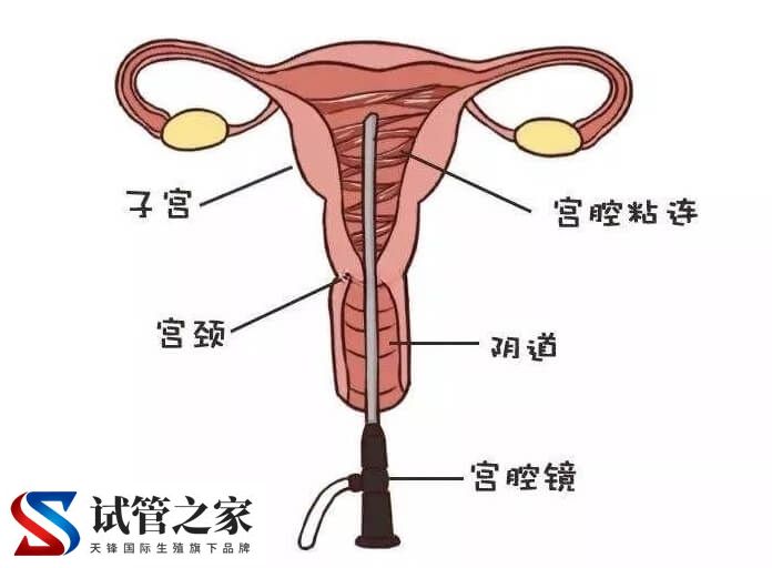 做宫腔镜检查痛不痛(图2) 做宫腔镜检查痛不痛(图2)