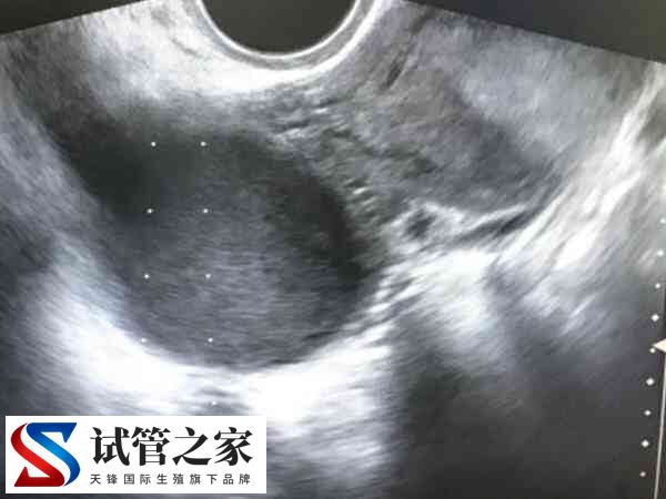 子宫内膜异位能不能做试管(图2)