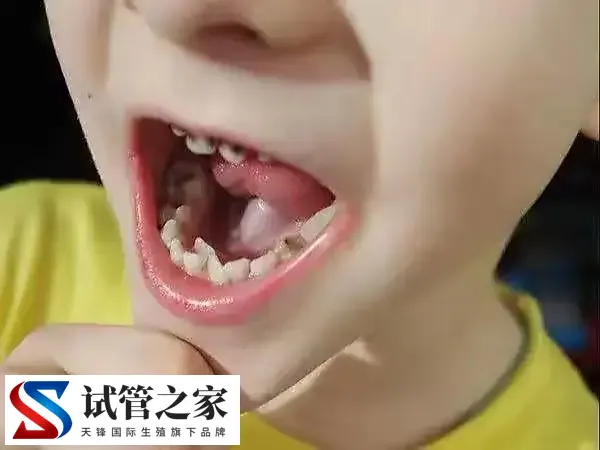 宝宝出牙晚是什么原因导致的