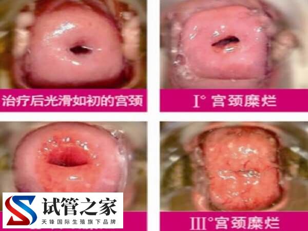 宫颈糜烂一二三度图片什么样(图1)